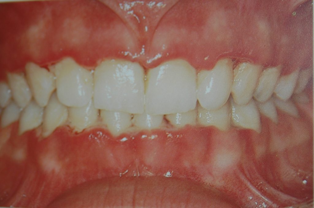 Tandvlees ontsteking en parodontitis wordt behandeld door tandarts R.A